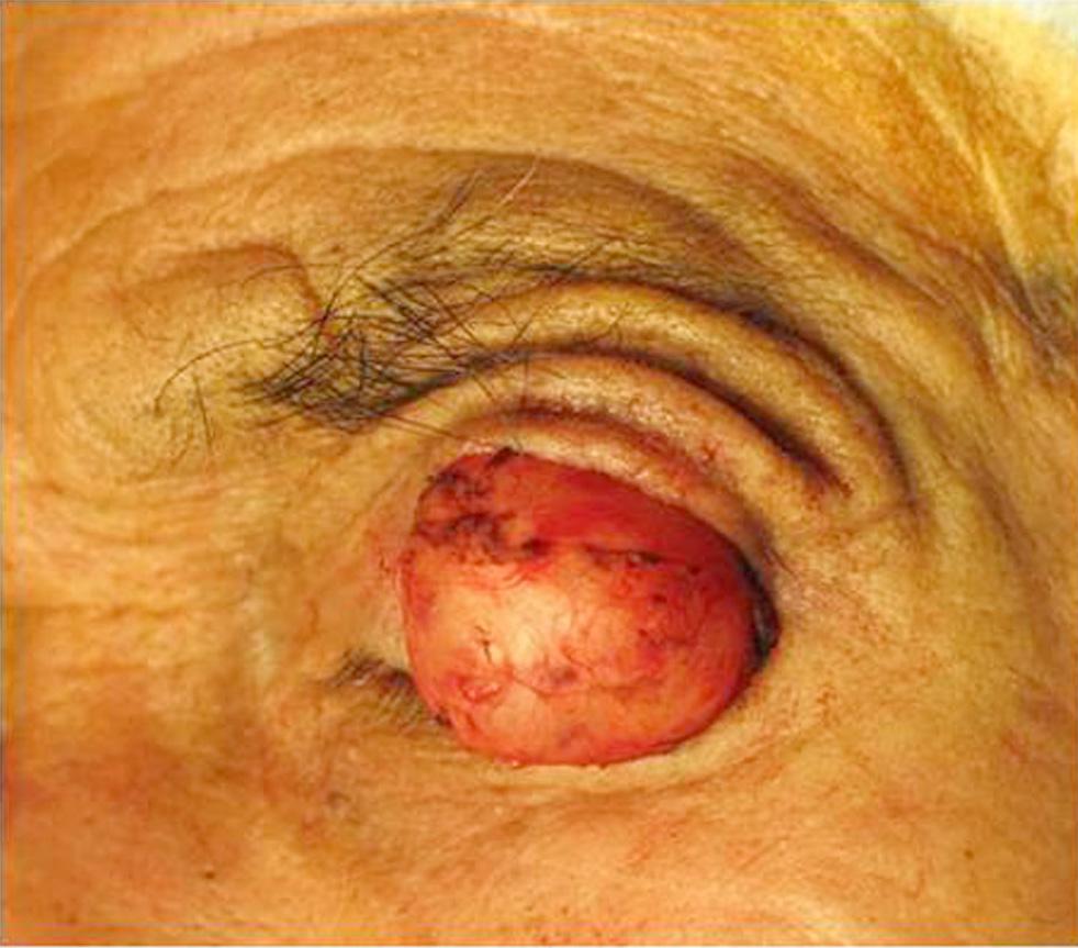 () Through upper lid crease incision and dissection,