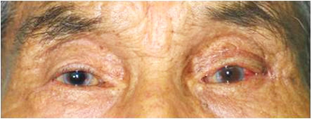 3,4,12 임상적으로 안와엽에서 생긴 다형성 샘종은 보통 수개월에서 1년 이상 의 기간에 걸쳐 위눈꺼풀의 상외측에서 별다른 증상 없이 Figure 5.
