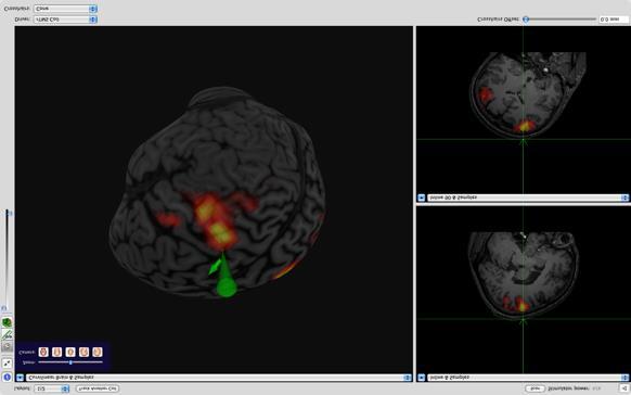 그림 4. Neuronavigator (Brainsight2) guides the motor region. Activation map obtained from a simple motor task was overlaid on top of the individual s own structural image 3.