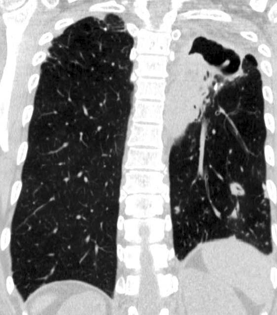 SH Park et al: Mycobacterium fortuitum lung disease Figure 1. A 53-year-old woman with Mycobacterium fortuitum lung disease.