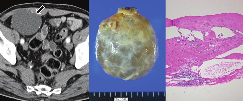 Contrast-enhanced CT scan shows a homogeneously low attenuated cystic mass without perceptional wall (arrow). Fig. 2. Pancreatic pseudocyst in a 49-year-old woman.