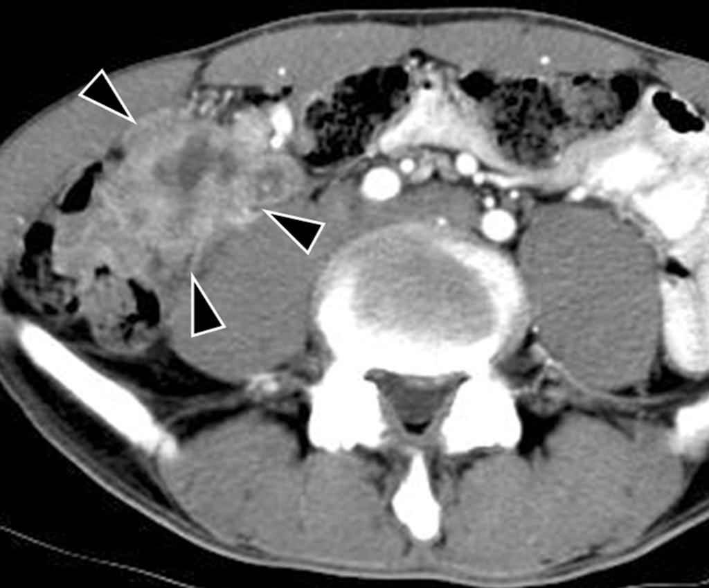 Pyogenic abscess with post-operative complication in a 63-year-old woman.