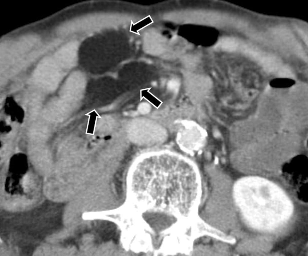 Contrast-enhanced CT scan shows a cystic mesenteric lesion (arrow) abut the thickened small bowel wall (arrowheads).
