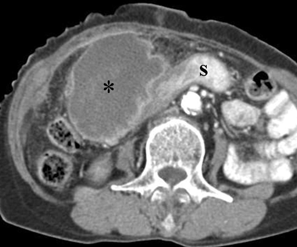 Fig. 16. Stomach cancer in a 77-year-old woman.