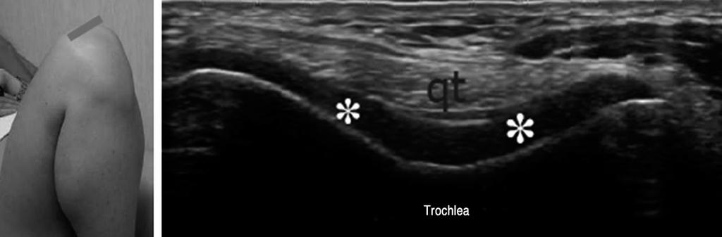 슬개건심부에서는관절막내 Hoffa 지방대를보고원위슬개건과경골단전면사이의심부슬개하점액낭 (deep infrapatellar bursa) 을확인한다. 점액낭의경도의팽창은작은삼각형의저음향부위로보이고이는정상적인것으로간주해야한다. Fig. 3.