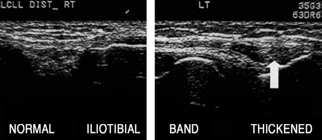 장경대증후군 (Iliotibial band syndrome, runner s knee) 외측대퇴과와장경대의반복적인마찰에의해발생하는건막염으로국소압통이있으며초음파상주변점액낭의부종과함께장경대의비후를관찰할수있다 (Fig. 18).