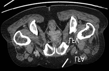 6) May Thurner 증후군의진단에있어서컴퓨터단층촬영정맥조영술, 자기공명정맥조영술 (magnetic resonance venography), 정맥내초음파 (intravenous ultrasound) 또는고식적정맥조영술은 May Thurner 증후군을탐지하는유용한진단도구가될수있다.