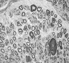 Dejerine-Sottas disease shows numerous onion bulb formations and demyelinated fibers(methylene blue 4 0 0 ) Fig 20