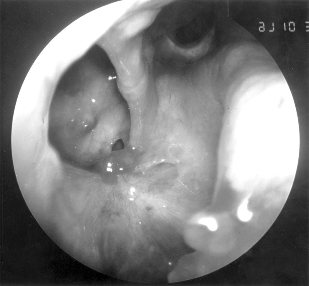 윤주헌 외 구개골 수직판 제거술을 통한 상악동 자연공 확장술 A B Fig. 3. Preoperative and postoperative computed tomography scans in the case that underwent modified middle meatal antrostomy. A. Preoperative finding shows total hazziness of the right maxillary sinus.