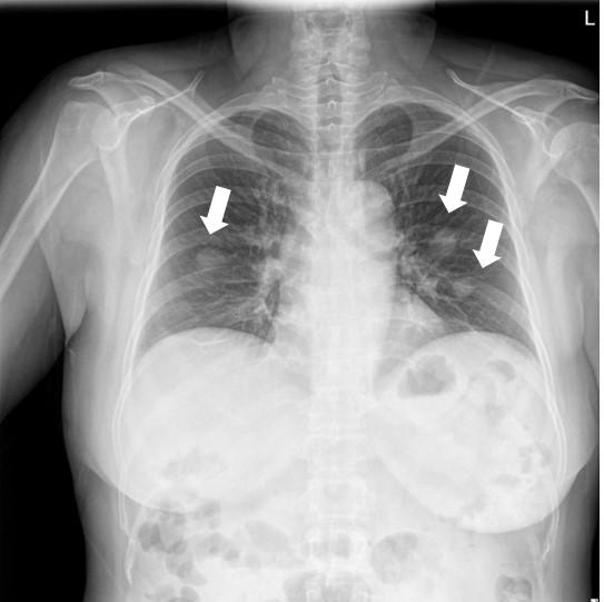 Fig. 3. Radiologic findings of chest.