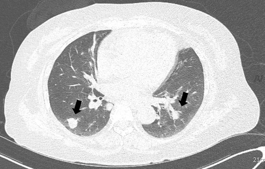 () Chest CT showing variable-sized nodule with or without cavitation in both lungs (Possible septic emboli, lack arrow). C Fig. 4.