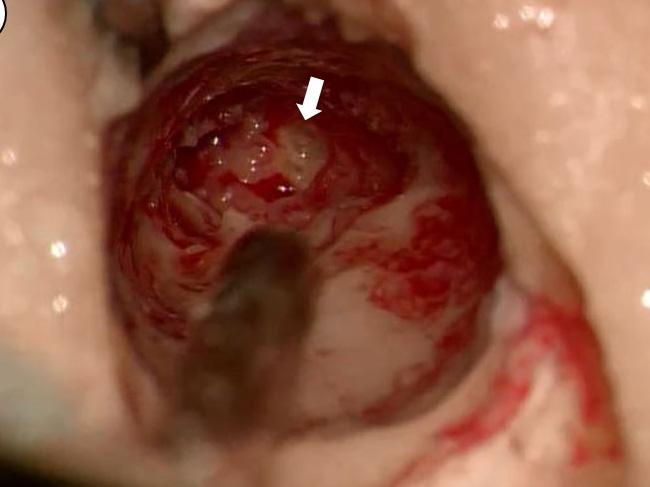 () Granulations in middle ear (White arrow), () cute inflammation with abscess (H&E, x2), (C) No definite vascular structure or
