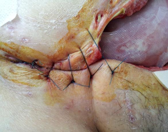 (A) The silicon sheet was holdedby the suture ligation to adjust to the wound which size was decreased.