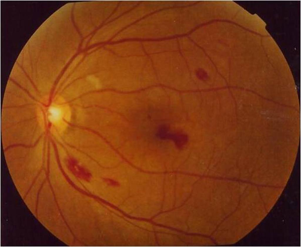 (B) The fundus of the left eye shows the multiple retinal hemorrhages in the posterior pole and preretinal hemorrhage in the macular area. Figure 2.