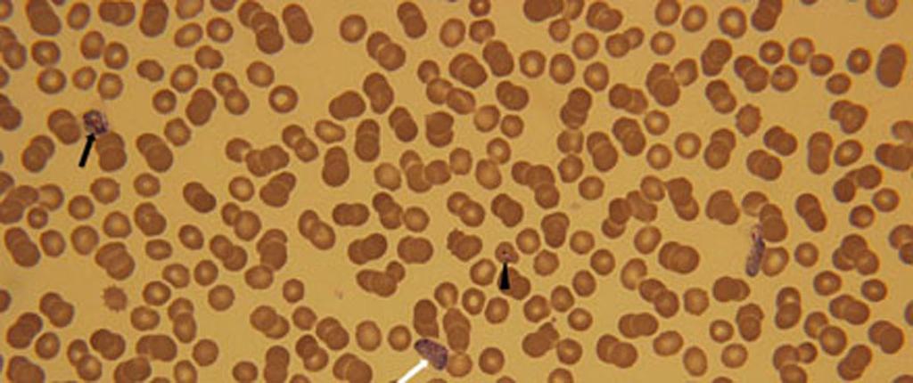Note that red blood cells hosting the schizont and the gametocyte are larger than the surrounding non-parasitized red blood cells. 내원일로부터 49일경과후우안후극부의망막출혈과황반부의망막앞출혈이발견되었고, 교정시력은우안 0.2, 좌안 0.