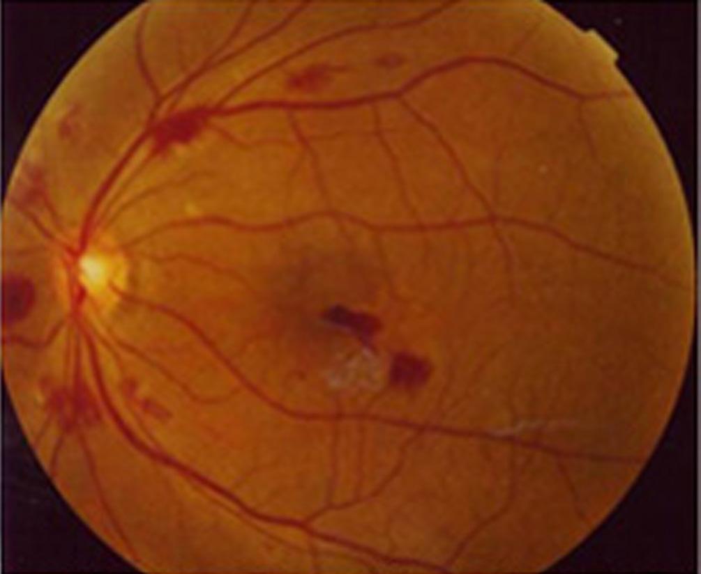 macula area of the right eye. The retinal hemorrhages of the left eye increased.