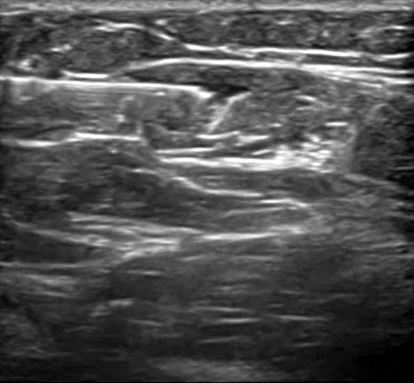 (Flexor pollicis longus, FPL), 상완이두근 (Biceps brachii), 상완근 (Brachialis), 완요골근 (Brachioradialis) 을중심으로각근육의주사방법과유의점에대해서기술하겠다. 1. 요측수근굴근 (FCR) 요측수근굴근의기시부는상완골의내측상과이며부착부는제 2, 3 수지의중수골부위이다.