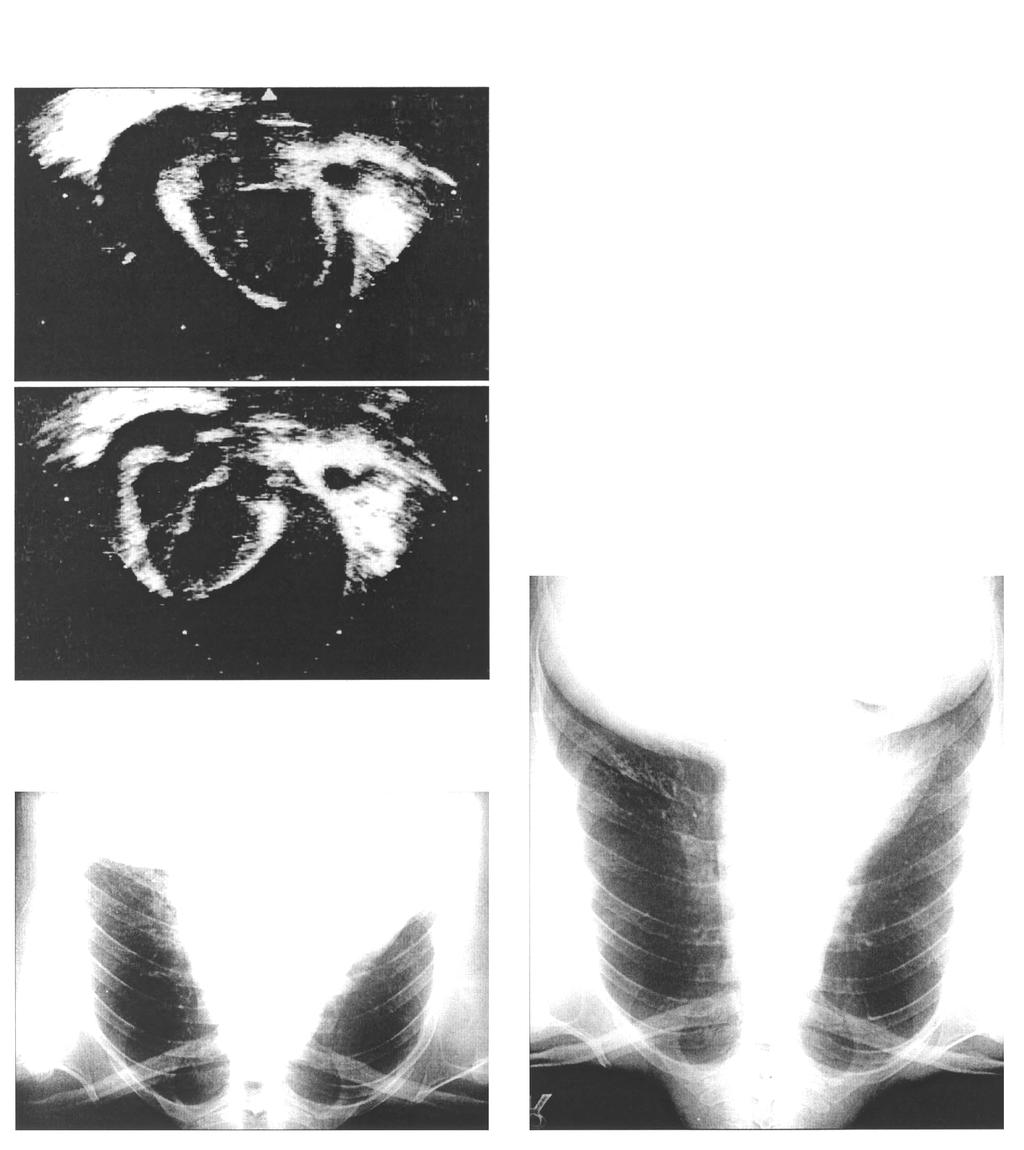 Fig. 3. Chest X-ray at 3rd hospital day reveals aggravation of cardiomegaly (CT ratio=0.7) and pericardial fluid drainage tube was inserted. Fig. 5.