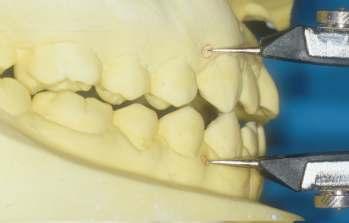 on semi-adjustable dental articulator at the