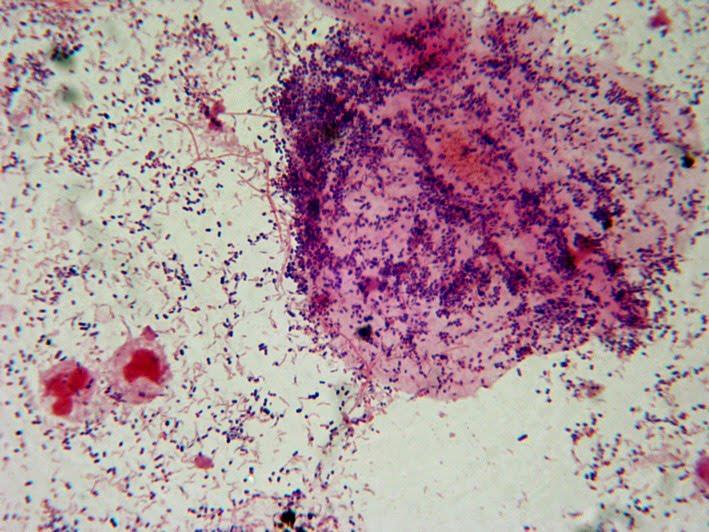 Gram stain of bacterial vaginosis (1000X, Gram Stain, Nikon)