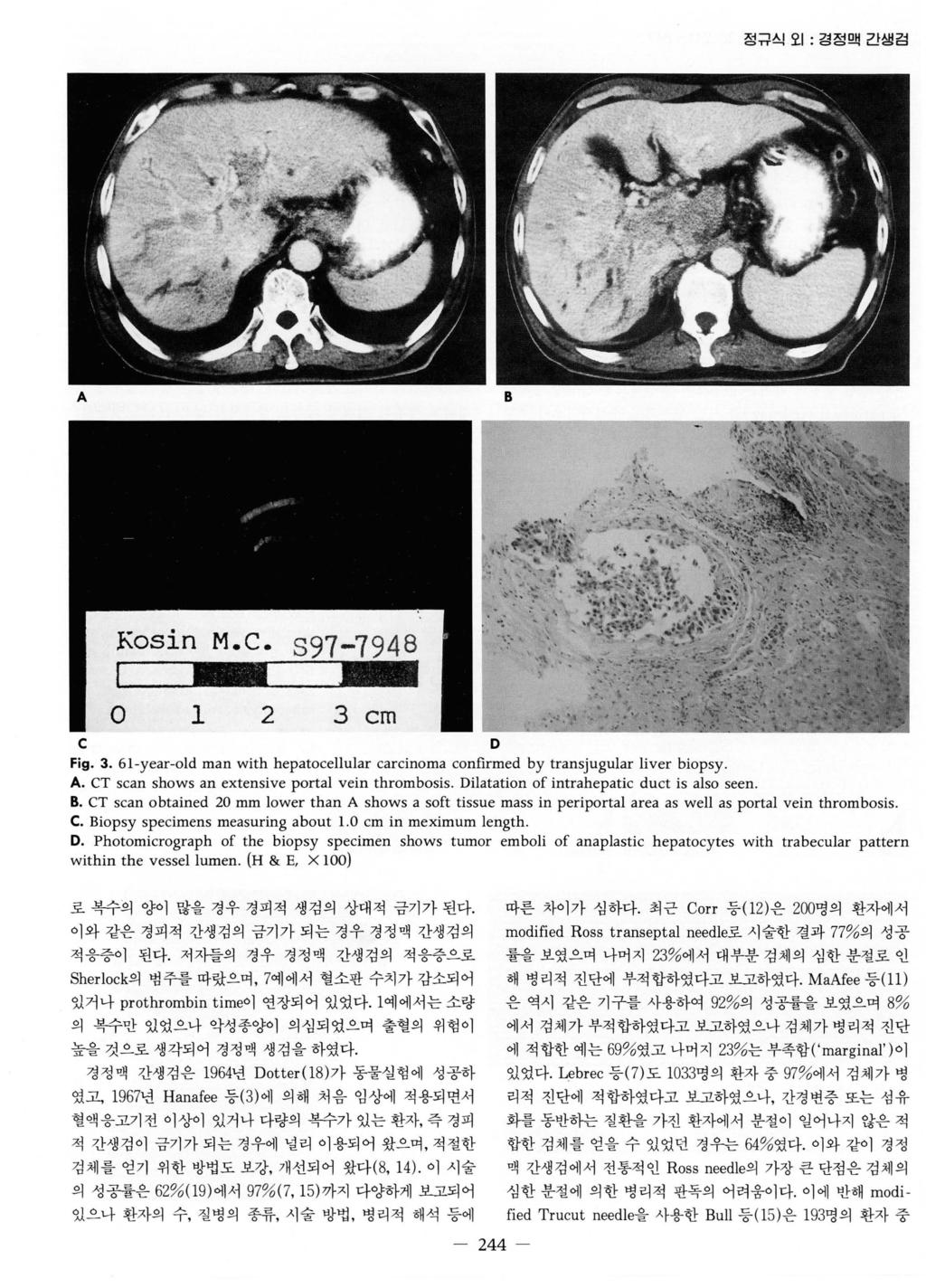 정뮤석오 1: 경정맥간생김 A B C D Fig. 3. 61-year-old man with hepatocellular carcinoma confirmed by transjugular liver biopsy. A. CT scan shows an extensive portal vein thrombosis.