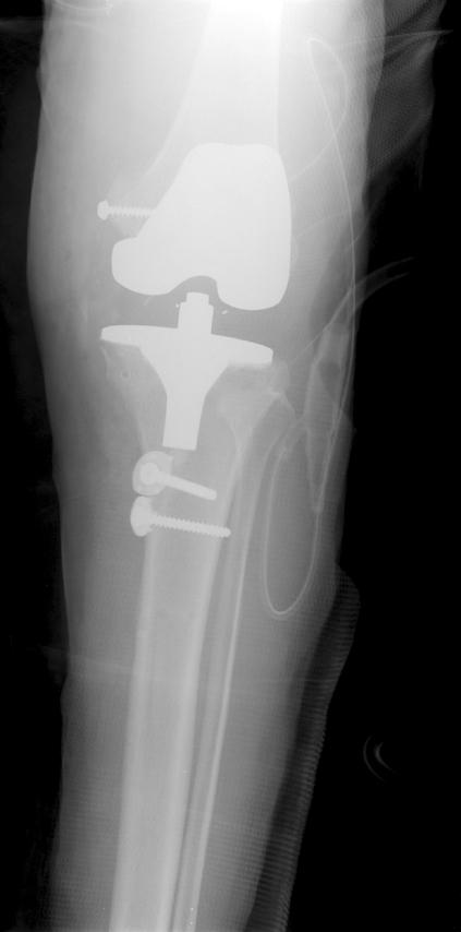(A) Internal fixation of avulsion fracture with 6.5 mm cancellous screw.