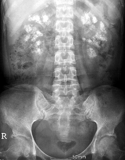 Renal Tubular Acidosis and Osteomalacia in Sjögren s Syndrome 221 과거력 : 신석회화증으로경과관찰중이며 1개월전제왕절개로출산하였다가족력 : 특이소견없었다. 진찰소견 : 내원당시측정한혈압은 120/80 mmhg, 맥박 76회 / 분, 호흡수 20회 / 분, 체온 36.