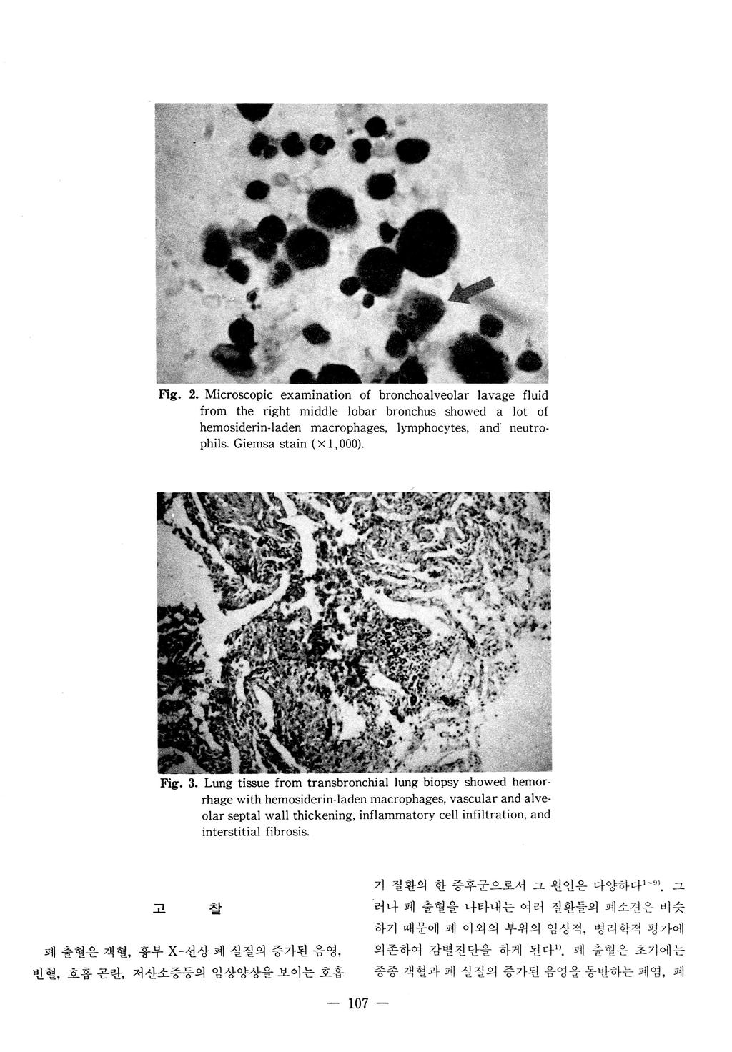 Fig. 2. Microscopic examination of bronchoalveolar lavage fluid from the right middle lobar bronchus showed a lot of hemosiderin-laden macrophages, lymphocytes, and' neutrophils.