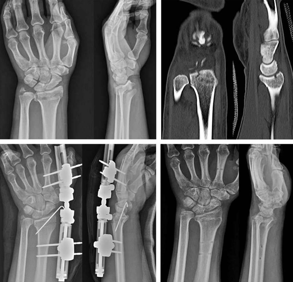J Korean Soc Surg Hand Vol. 20, No. 1, March 2015 하고자하였다. 대상및방법 2013년 3월부터 2014년 2월까지본원에서전위된원위요골의불안정한골절로수술받고 3개월이상추시가가능했던 38명의환자를대상으로하였다.