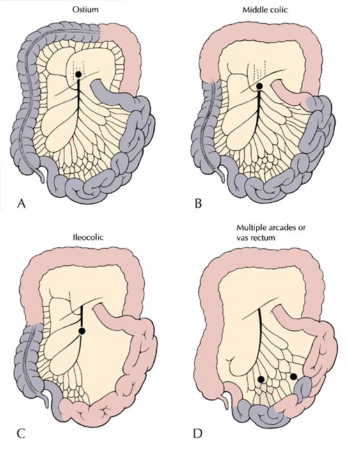 홍석경 : 허혈성 장질환 5 Figure 2. The territory of bowel ischemia according to splanchnic vascular occlusion 흔하지 않다.