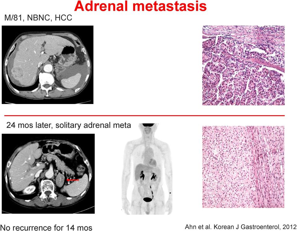 adrenal meta No recurrence for 14