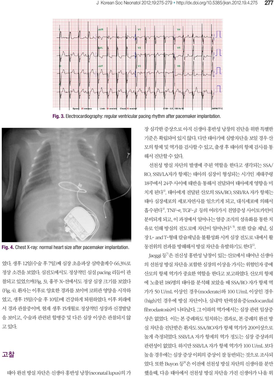 환자는 이후로 양호한 경과를 보이며 코위관 영양을 시작하 였고, 생후 15일(수술 후 10일)에 건강하게 퇴원하였다. 이후 외래에 서 경과 관찰중이며, 현재 생후 15개월로 정상적인 성장과 신경발달 을 보이고, 수술과 관련된 합병증 및 다른 심장 이상은 관찰되지 않 고 있다.