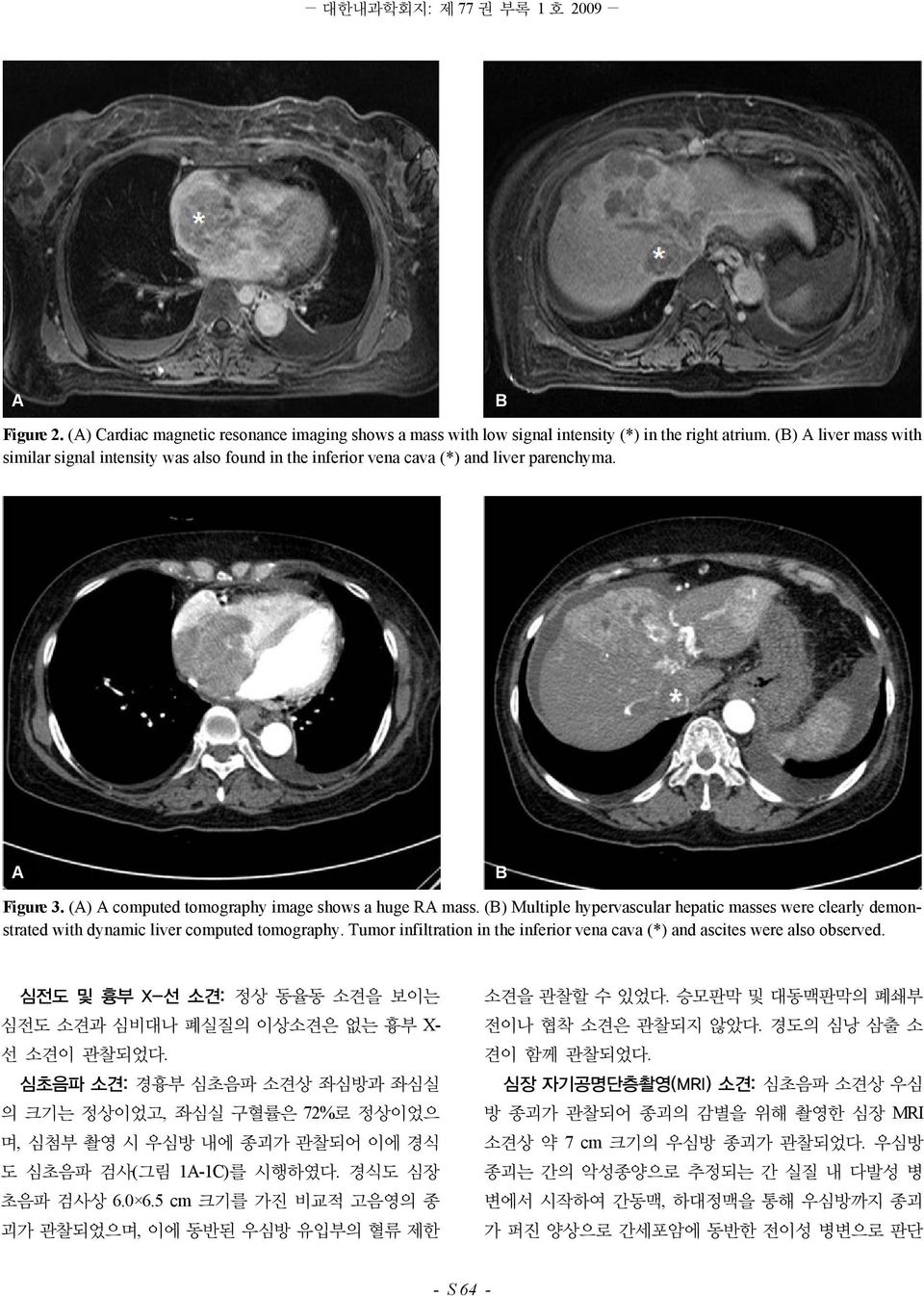 () Multiple hypervascular hepatic masses were clearly demonstrated with dynamic liver computed tomography. Tumor infiltration in the inferior vena cava (*) and ascites were also observed.