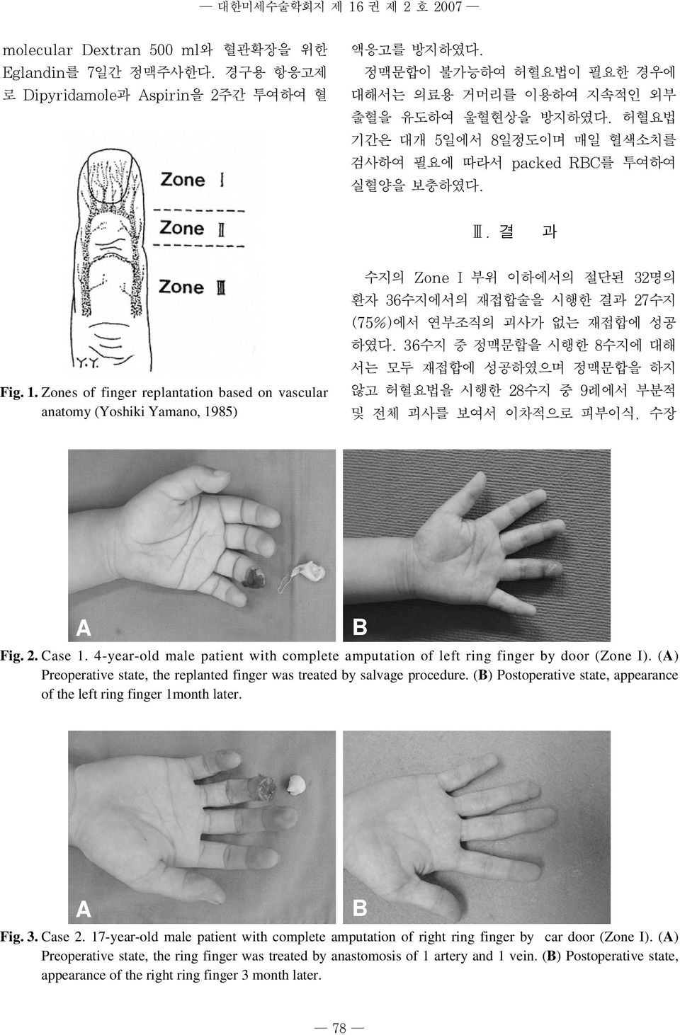 Zones of finger replantation based on vascular anatomy (Yoshiki Yamano, 1985) 수지의 Zone I 부위 이하에서의 절단된 32명의 환자 36수지에서의 재접합술을 시행한 결과 27수지 (75%)에서 연부조직의 괴사가 없는 재접합에 성공 하였다.