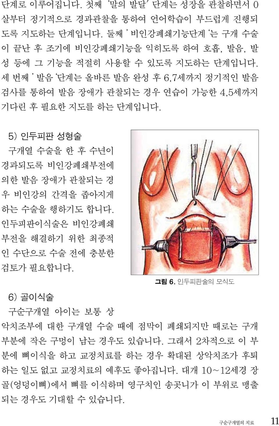 세번째 발음 단계는 올바른 발음 완성 후 6,7세까지 정기적인 발음 검사를 통하여 발음 장애가 관찰되는 경우 연습이 가능한 4,5세까지 기다린 후 필요한 지도를 하는 단계입니다.