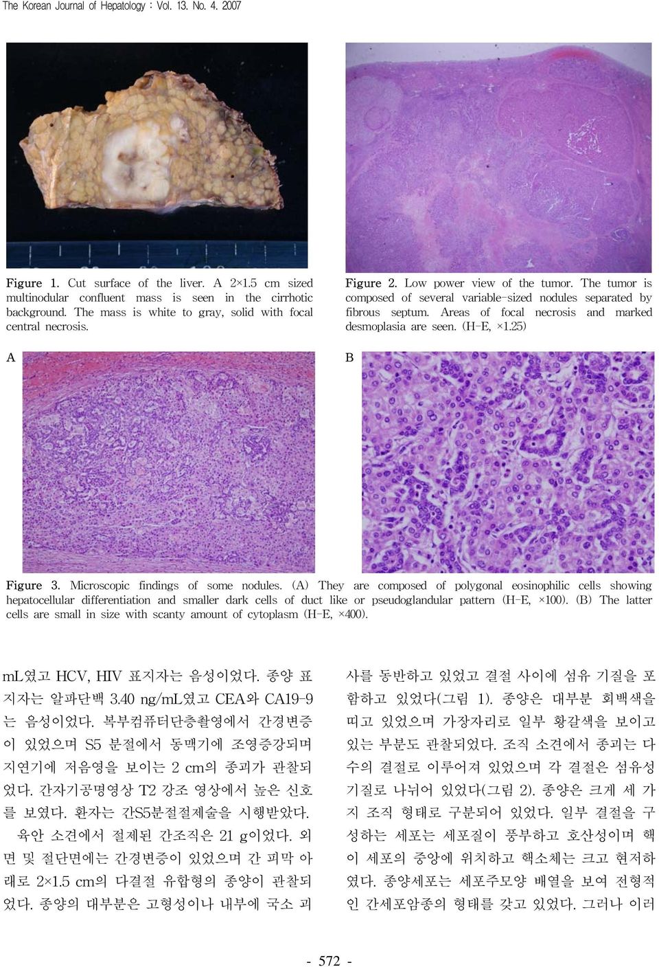reas of focal necrosis and marked desmopl asia are seen. (H-E, 1. 25) Fi g ure 3. Microscopic findings of some nodules.