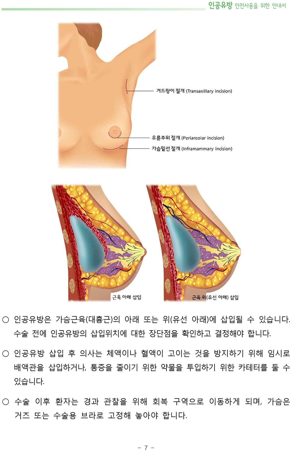 인공유방 삽입 후 의사는 체액이나 혈액이 고이는 것을 방지하기 위해 임시로 배액관을 삽입하거나, 통증을 줄이기