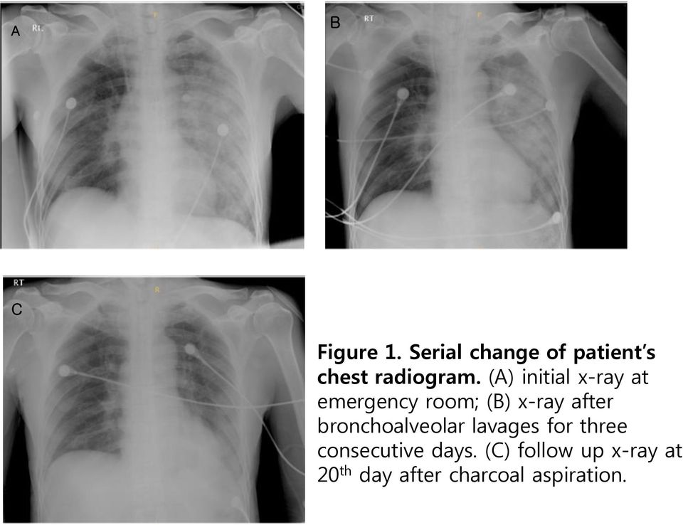(A) initial x-ray at emergency room; (B) x-ray after
