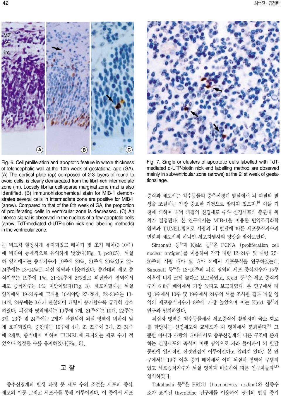 Loosely fibrilar cell-sparse marginal zone (mz) is also identified. (B) Immunohistochemical stain for MIB-1 demonstrates several cells in intermediate zone are positive for MIB-1 (arrow).