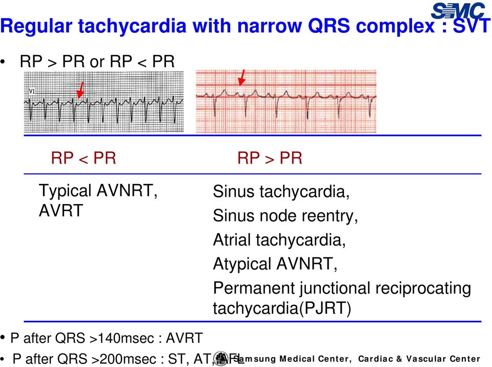 Atrial tachycardia, Atypical AVNRT, Permanent junctional reciprocating