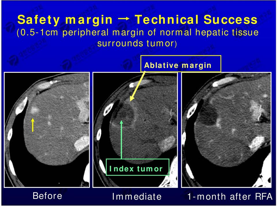 hepatic tissue surrounds tumor) Ablative