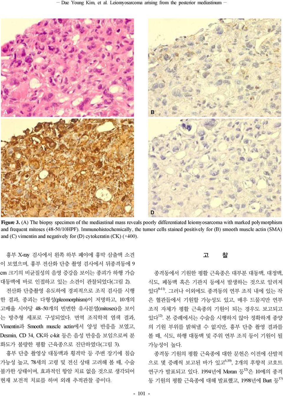Immunohistochemically, the tumor cells stained positively for (B) smooth muscle actin (SMA) and (C) vimentin and negatively for (D) cytokeratin (CK) ( 400).