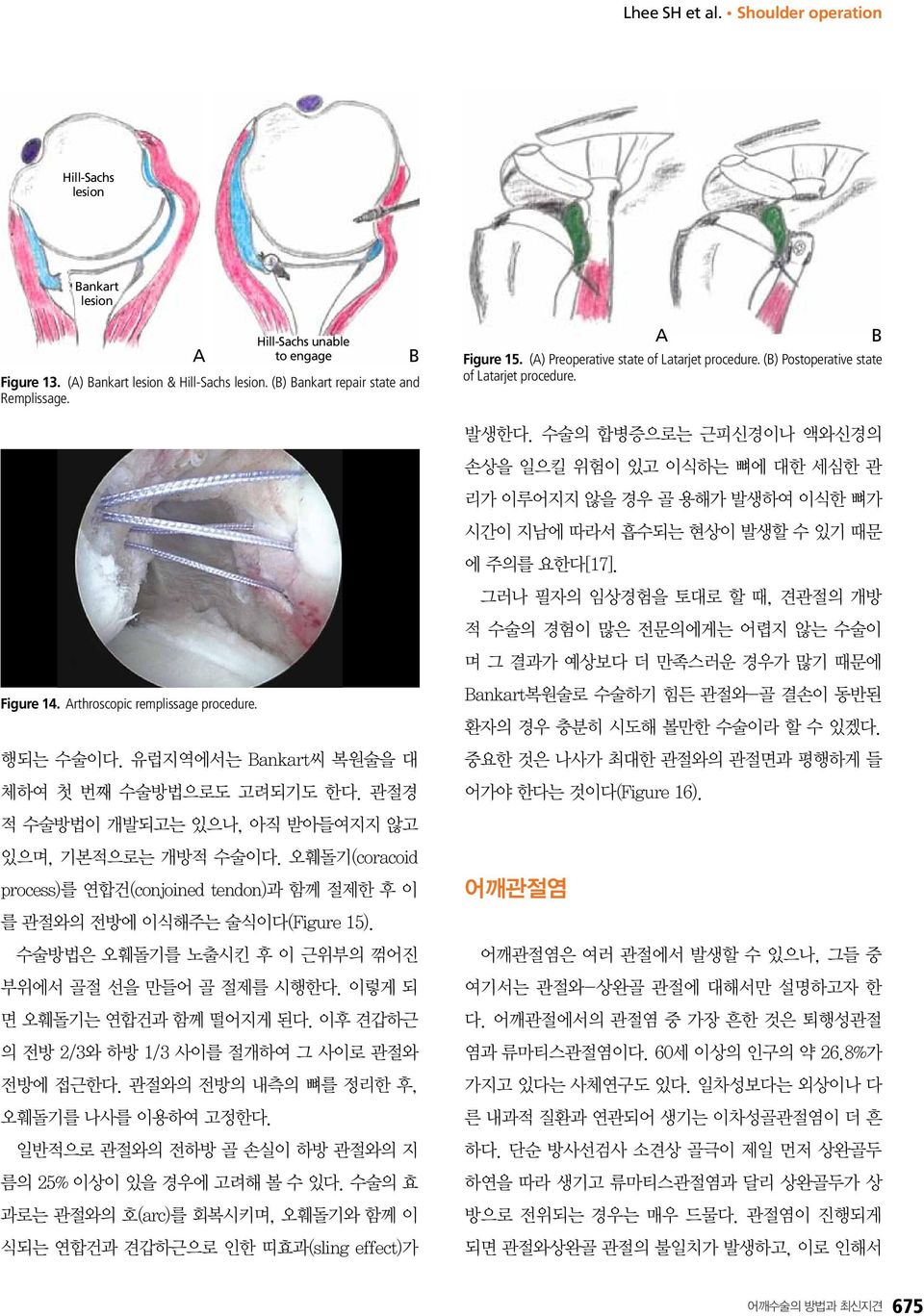 수술의 합병증으로는 근피신경이나 액와신경의 손상을 일으킬 위험이 있고 이식하는 뼈에 대한 세심한 관 리가 이루어지지 않을 경우 골 용해가 발생하여 이식한 뼈가 시간이 지남에 따라서 흡수되는 현상이 발생할 수 있기 때문 에 주의를 요한다[17].