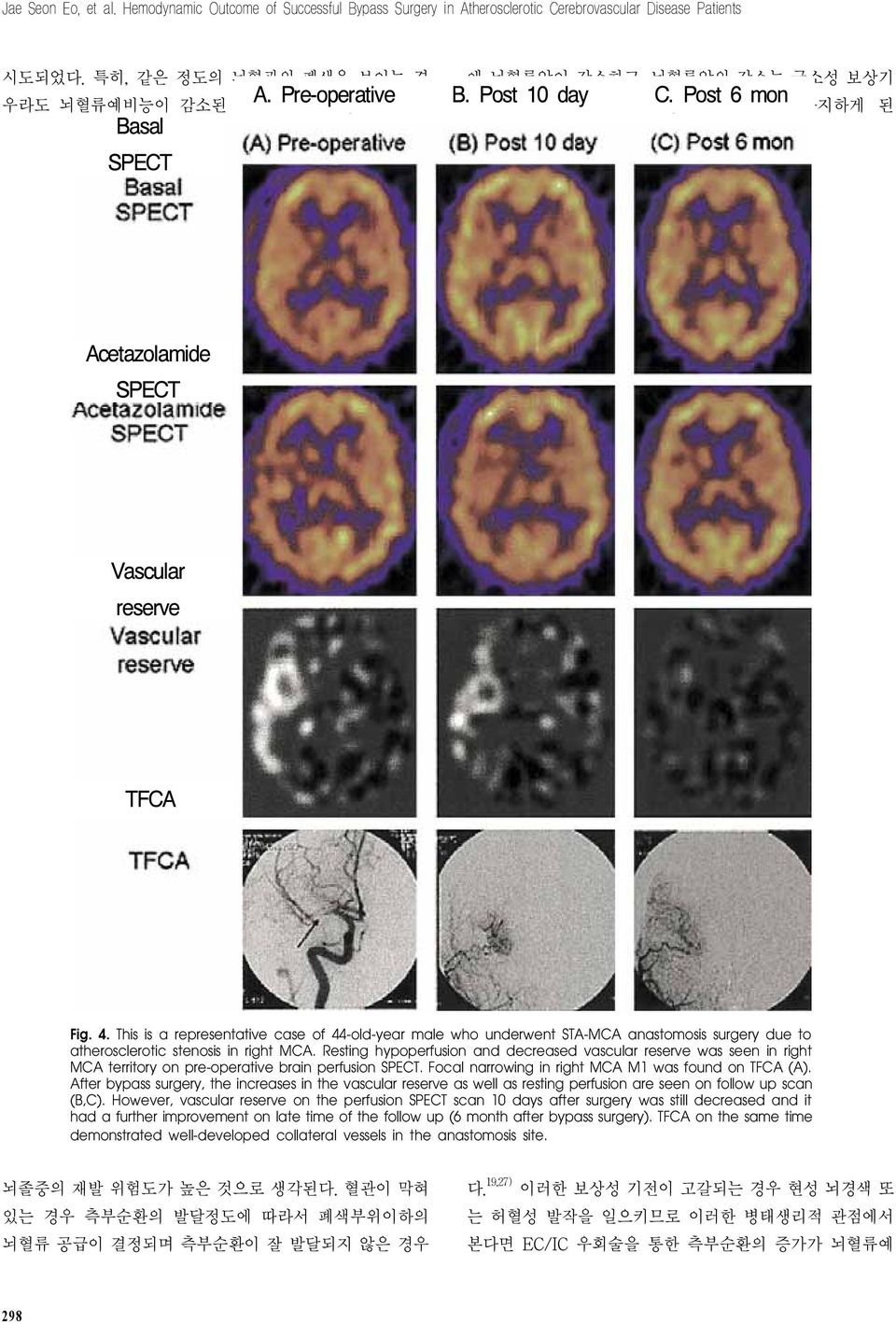 Post 6 mon 전에 의하여 뇌혈관을 확장시켜 뇌혈류를 유지하게 된 Acetazolamide SPECT Vascular reserve TFCA Fig. 4.