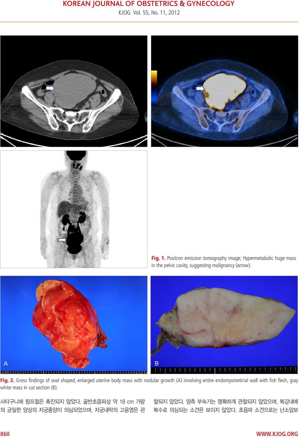 Positron emission tomography image; Hypermetabolic huge mass in the pelvic cavity, suggesting malignancy (arrow). A B Fig.