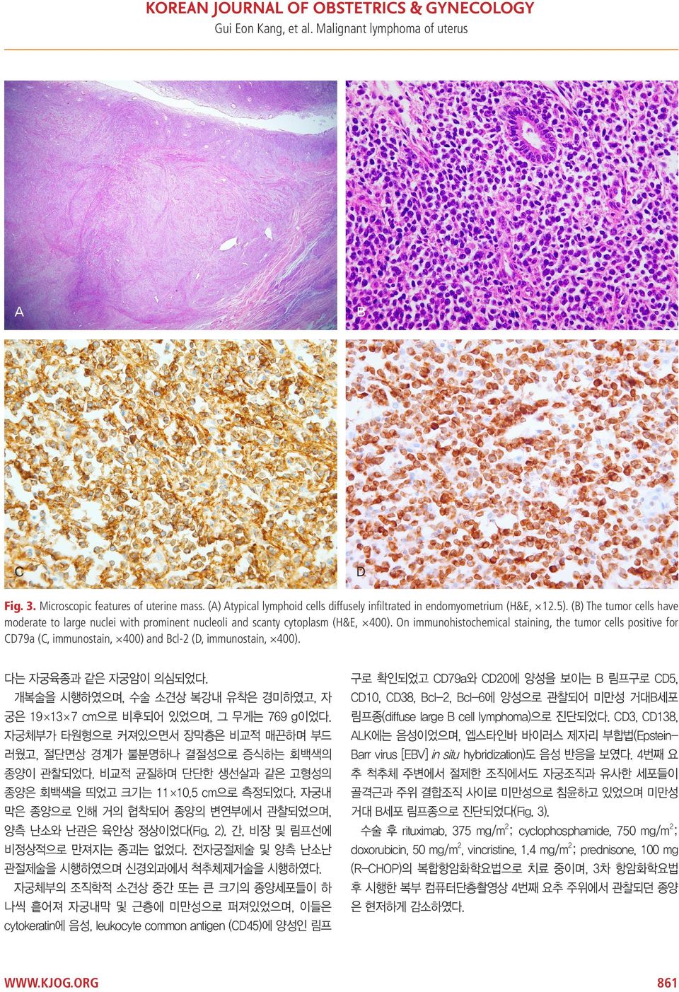 On immunohistochemical staining, the tumor cells positive for CD79a (C, immunostain, 400) and Bcl-2 (D, immunostain, 400). 다는 자궁육종과 같은 자궁암이 의심되었다.
