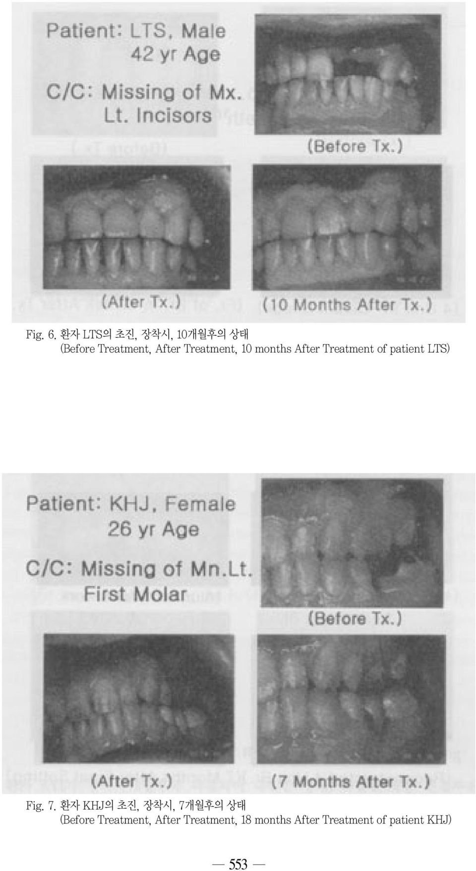 Treatment, 10 months After Treatment of patient LTS) Fig.