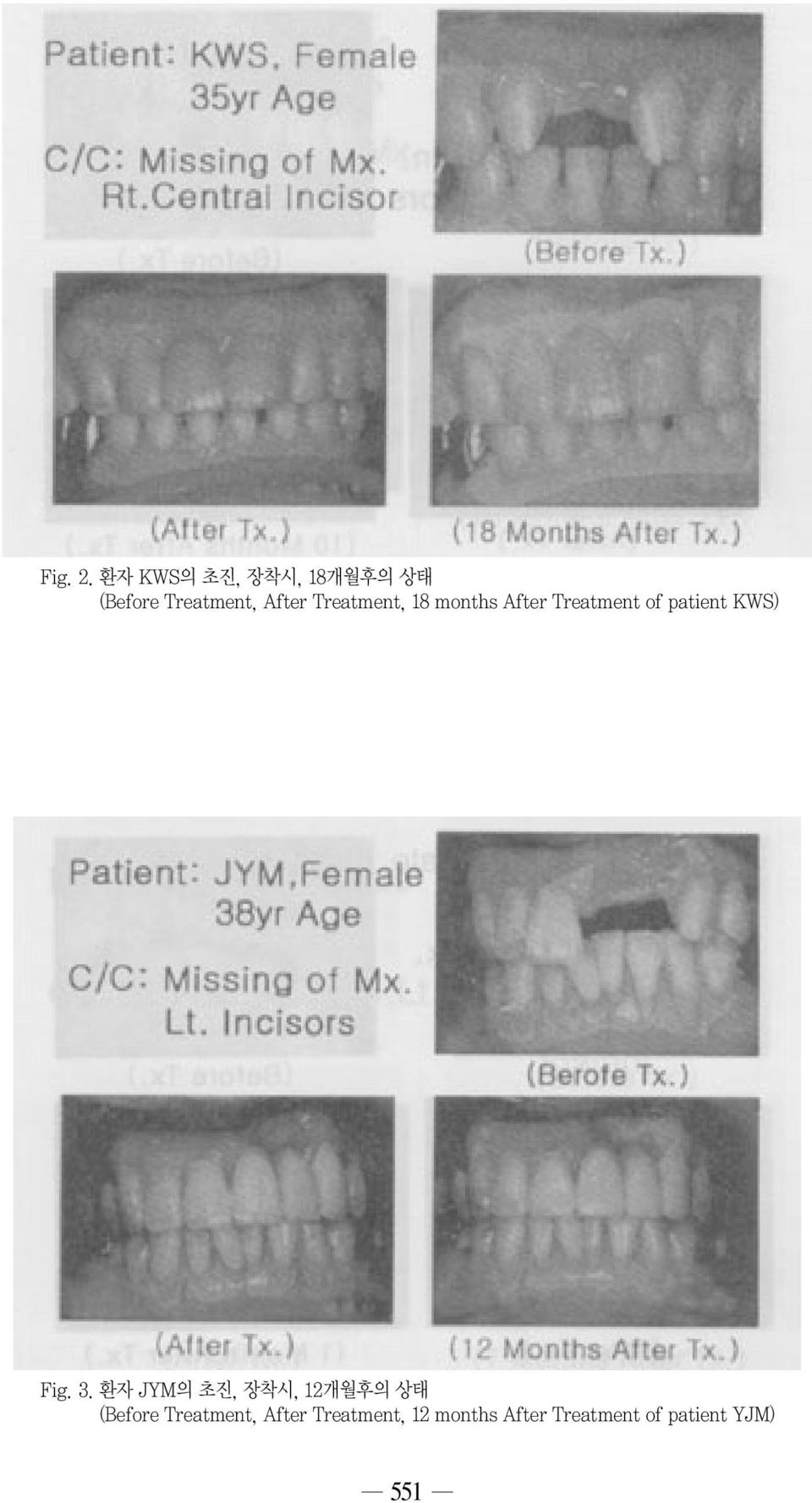 Treatment, 18 months After Treatment of patient KWS) Fig.