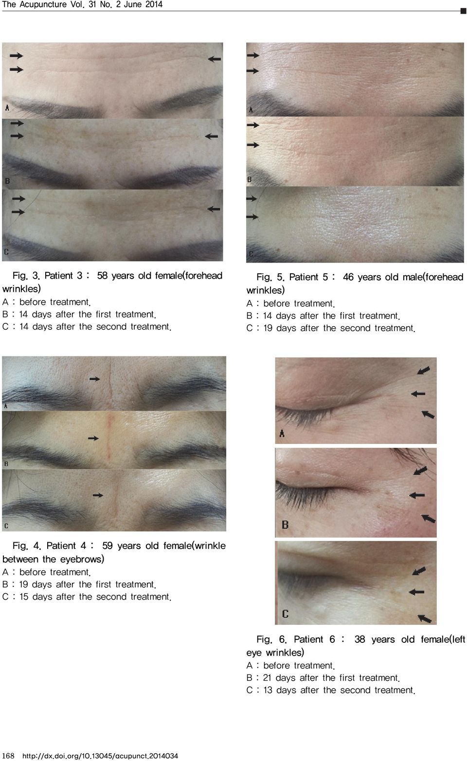Patient 5 : 46 years old male(forehead C : 19 days after the second treatment. Fig. 4. Patient 4 : 59 years old female(wrinkle between the eyebrows) B : 19 days after the first treatment.