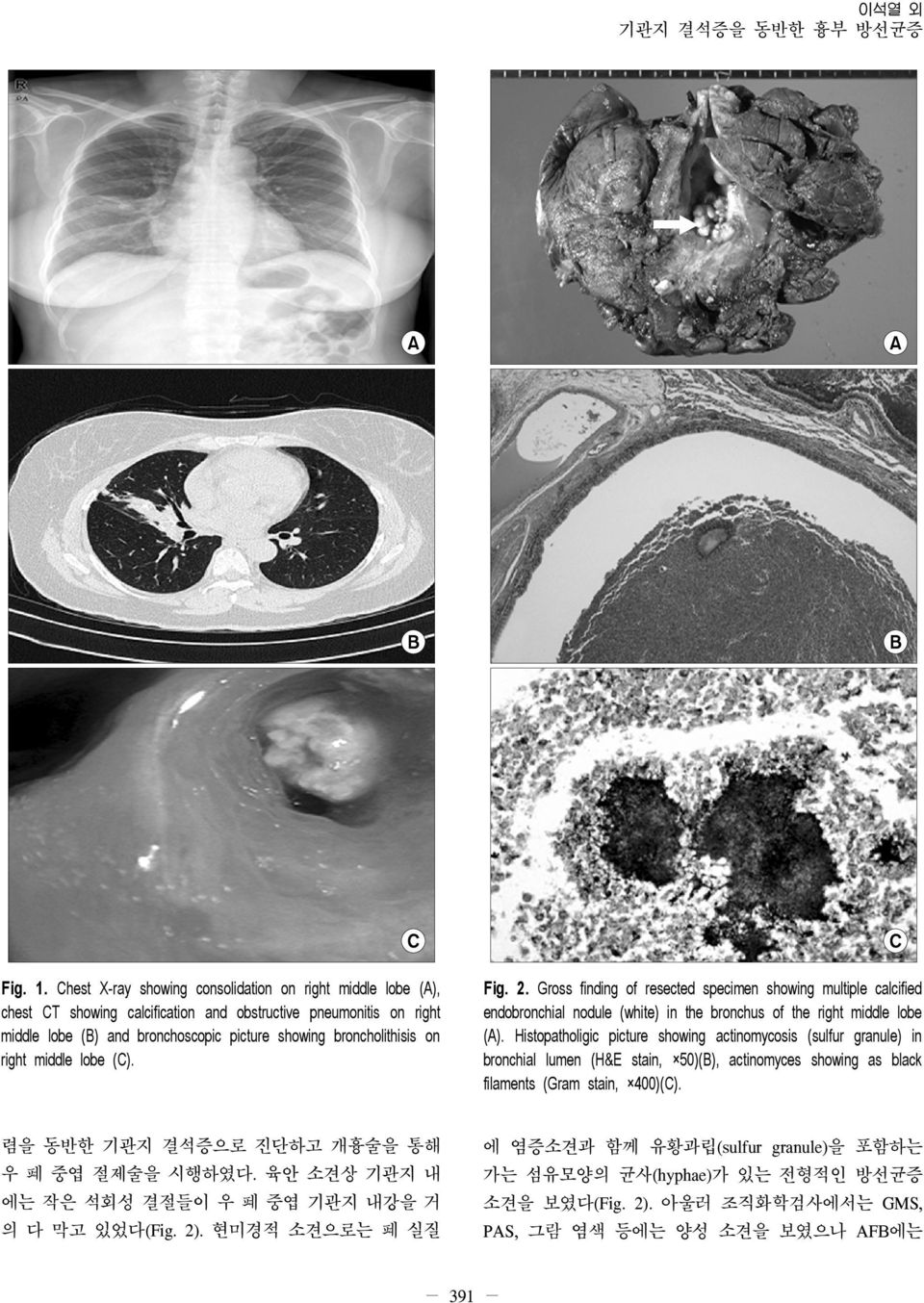 right middle lobe (C). Fig. 2. Gross finding of resected specimen showing multiple calcified endobronchial nodule (white) in the bronchus of the right middle lobe (A).